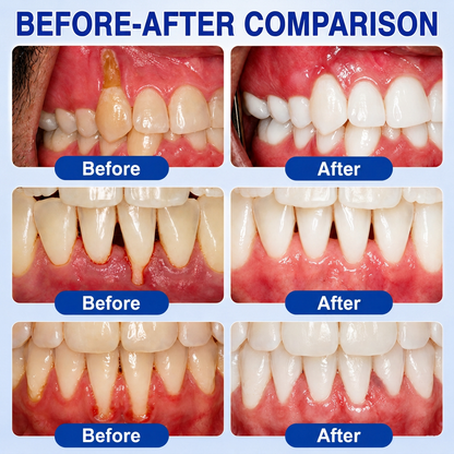 👨‍⚕️✅🦷HISKIN® GumRevive Advanced Gum Defence & Repair Gel