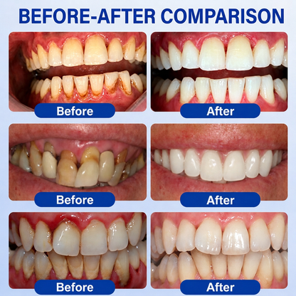 👨‍⚕️✅🦷HISKIN® GumRevive Advanced Gum Defence & Repair Gel